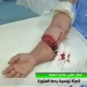 المنستير : فريق طبي تونسي 100 % يتمكن من زرع يد مبتورة لإمراة تونسية