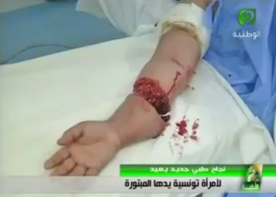 المنستير :  فريق طبي تونسي 100 % يتمكن من زرع يد مبتورة لإمراة تونسية