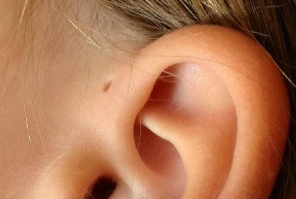 الثقب الصغير فوق الأذن