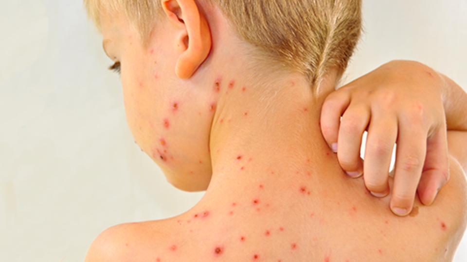 فيروس الحصبة