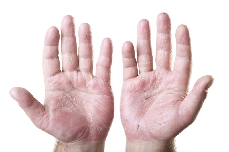 نصائح لعلاج تشقّق اليدين في فصل الشتاء