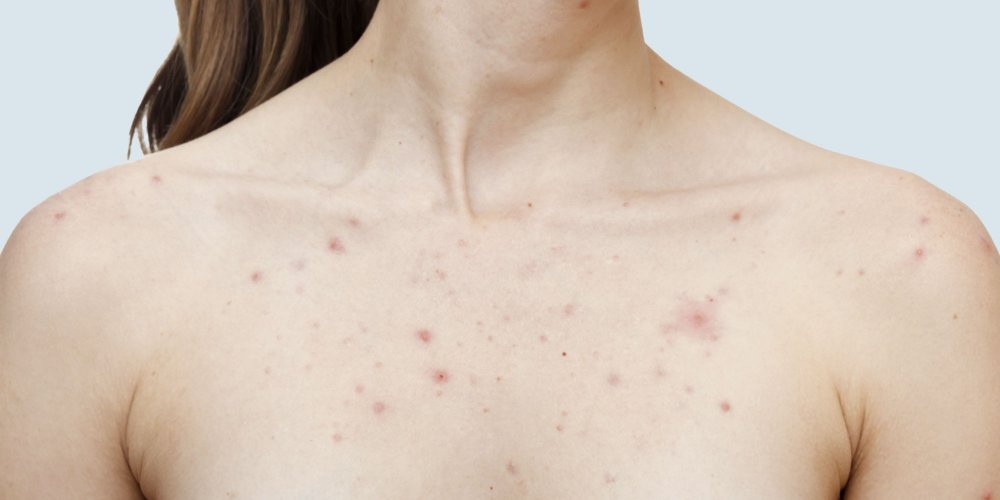 الحصبة الكبار الشباب النساء الرجال 