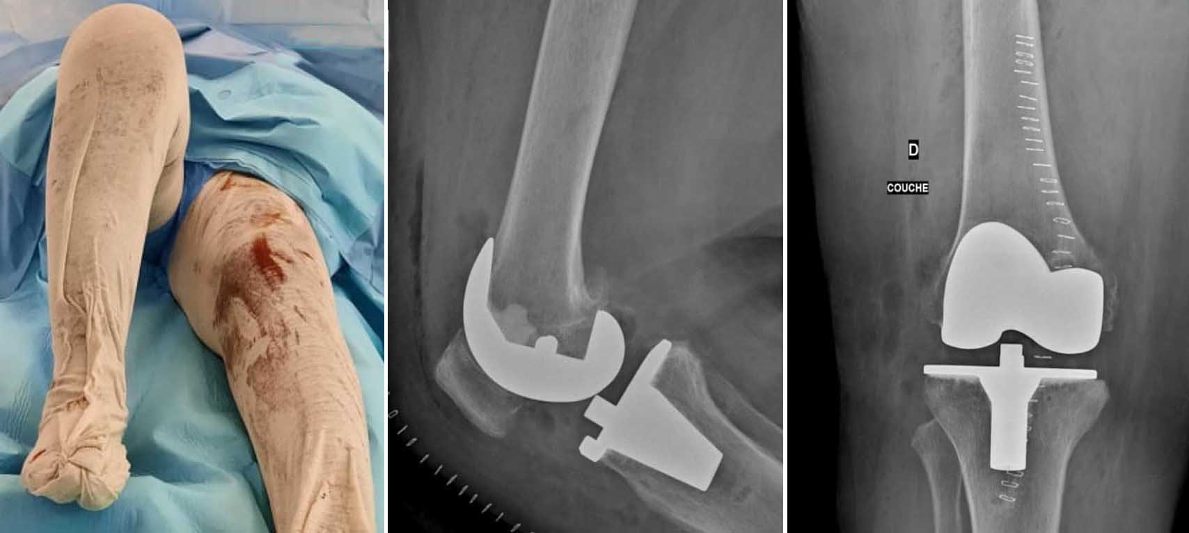 استبدال مفصل الركبة
