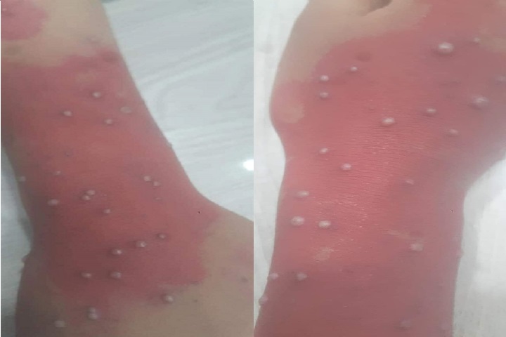 جدري القردة - صفاقس